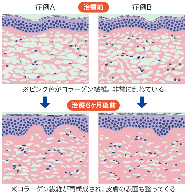 コラーゲンが再構築される