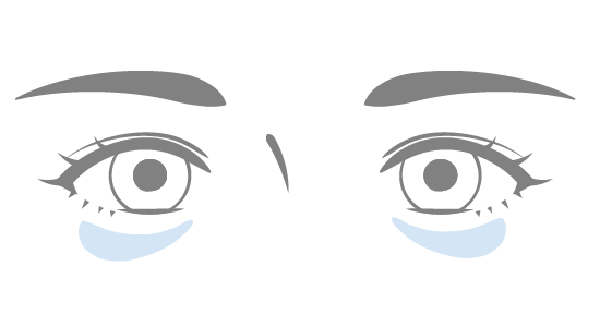 セオリークリニックで改善できる目の下のたるみ・クマの種類 - 膨らみ（軽度）