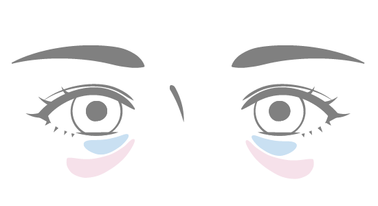 セオリークリニックで改善できる目の下のたるみ・クマの種類 - 膨らみ（中度）