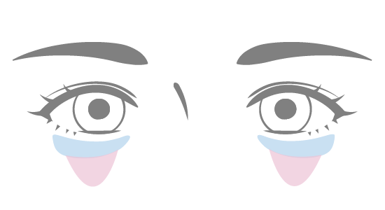 セオリークリニックで改善できる目の下のたるみ・クマの種類 - 膨らみ（強度）