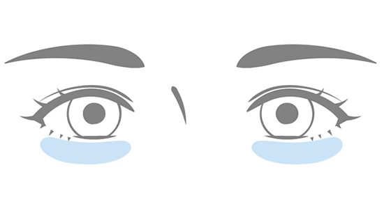 セオリークリニックで改善できる目の下のたるみ・クマの種類 - くぼみタイプ