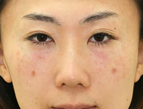 長谷川さん、セオリークリニックの目の下のたるみ治療体験レポート画像6
