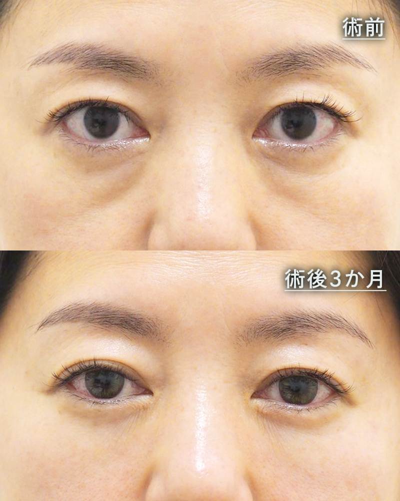 脱脂術+リポトランスファー+脂肪注入before・after1