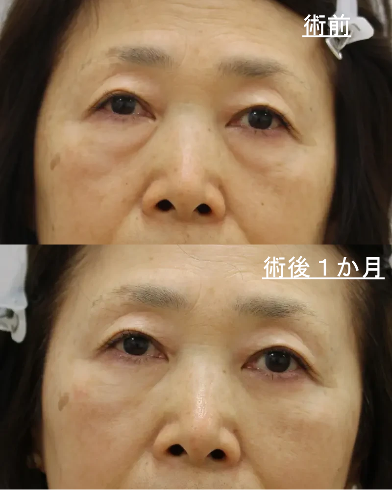経結膜脱脂＋ピュアグラフティングbefore・after1